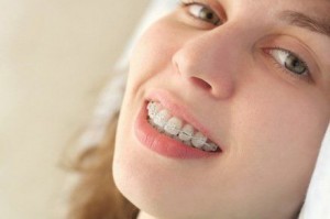 ecco un esempio di apparecchio denti