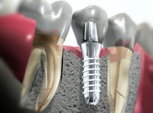 denti sani a Bari con l'implantologia a bari denti sani a Bari con l'implantologia a bari