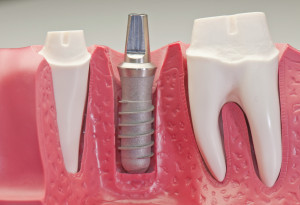 le fasi in cui si articolano operazioni di implantologia dentale