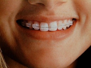 ragazza con apparecchio installato a bari